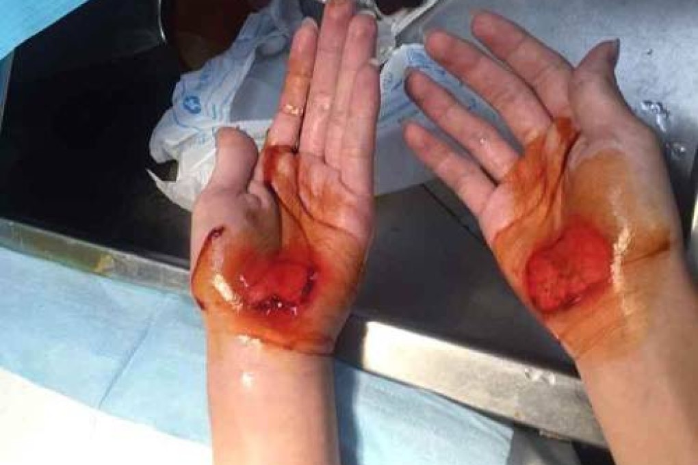 A photo posted on social media that purports to show one pupil's hands after the punishment. Photo: SCMP Pictures