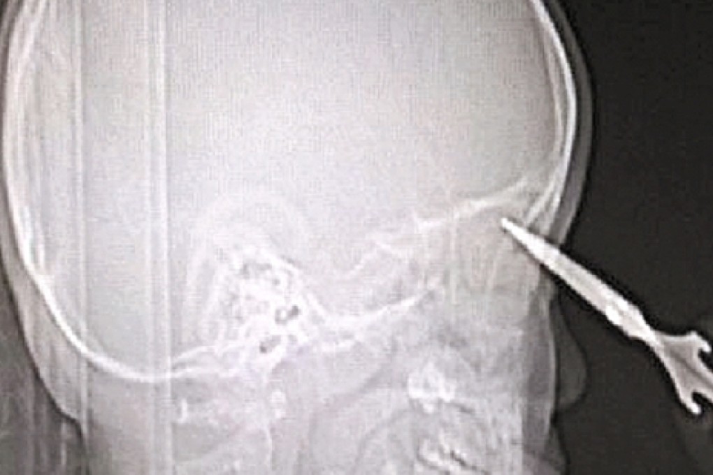 An X-ray image shows the scissors inserted in the boy's right nostril, narrowly missing the membranes of his brain tissue. Photo: Qiangjiang Evening News