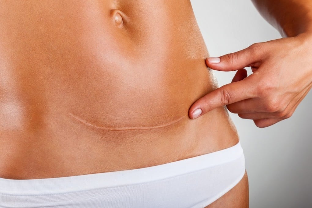 Mothers with a caesarean scar on their uterus were 24 times more likely to develop morbidly adherent placenta. Photo: SCMP Pictures