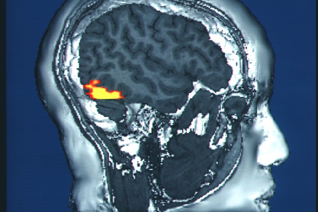 Researchers say a super-recogniser might have a slightly larger fusiform face area in the brain than a face-blind person, or the person might show more activity in this area when looking at images of a face. Photo: Wikimedia Commons