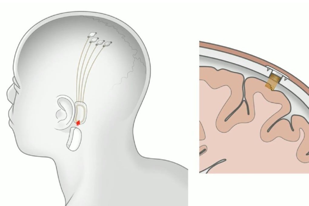 The threads are thinner than a human hair. (Picture: Neuralink)