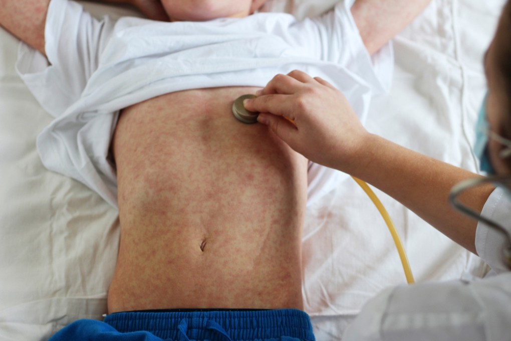 7 facts you need to know about measles