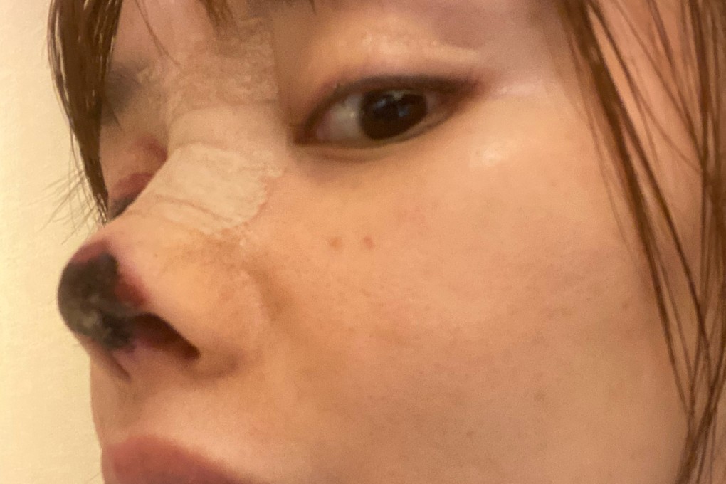 Gao Liu posted candid pictures of her post-surgery face showing part of her nose blackened with dead flesh. Photo: Weibo