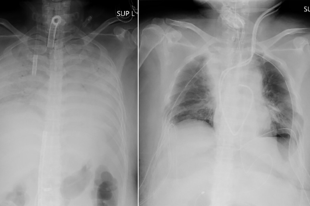 This combination of radiographs shows the chest of the patient before the lung transplant (left) and after the surgery (right). Photo: Kyoto University Hospital via AP