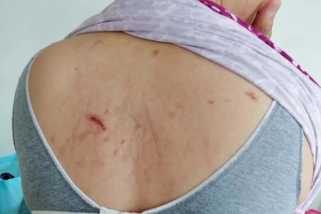 Bruises and scratches on the back of Filipino domestic helper Eden. Photo: Handout