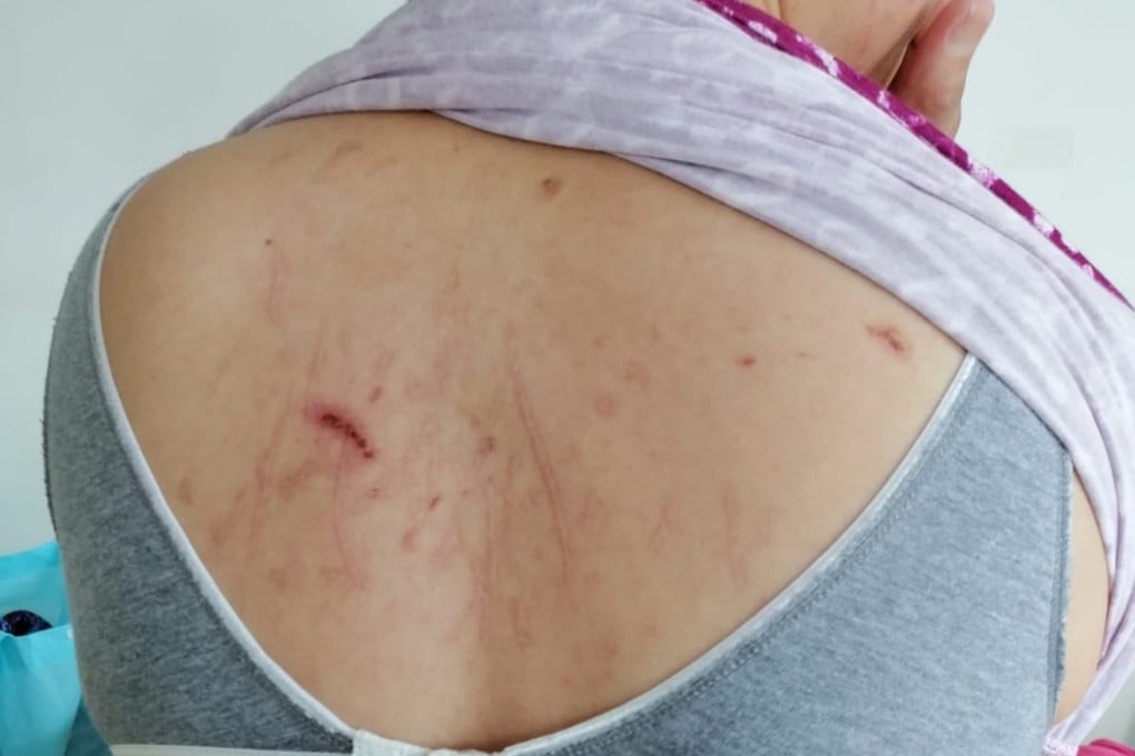 Bruises and scratches on the back of Filipino domestic helper Eden. Photo: Handout