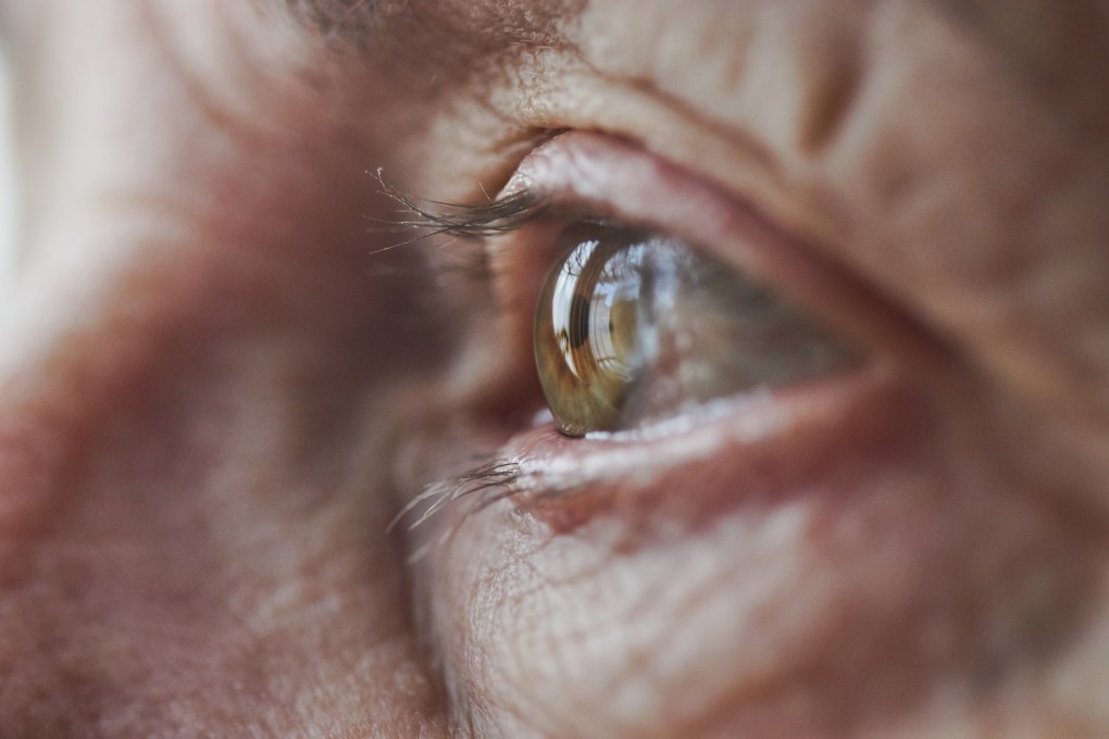 The University of California, San Francisco team examined tiny blood vessels at the back of the eyes of elderly people with and without APOE4 gene mutations, the most prevalent genetic risk for Alzheimer’s disease. Photo: Getty Images