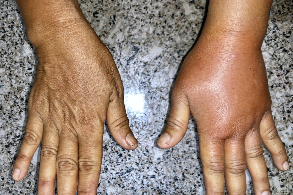 Lymphoedema is a painful condition, sometimes caused by breast cancer surgery and radiation therapy. Photo: Shutterstock