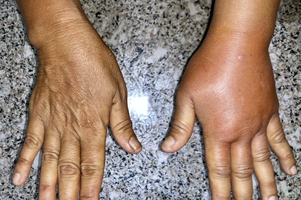 Lymphoedema is a painful condition, sometimes caused by breast cancer surgery and radiation therapy. Photo: Shutterstock