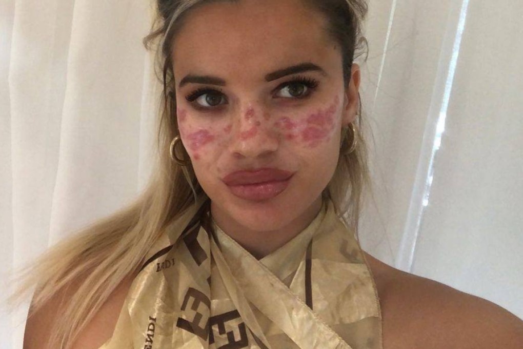 A case of at-home microneedling gone wrong. It’s one of a number of viral beauty hacks pushed on social media platform TikTok that dermatologists say you should avoid. Photo: Instagram