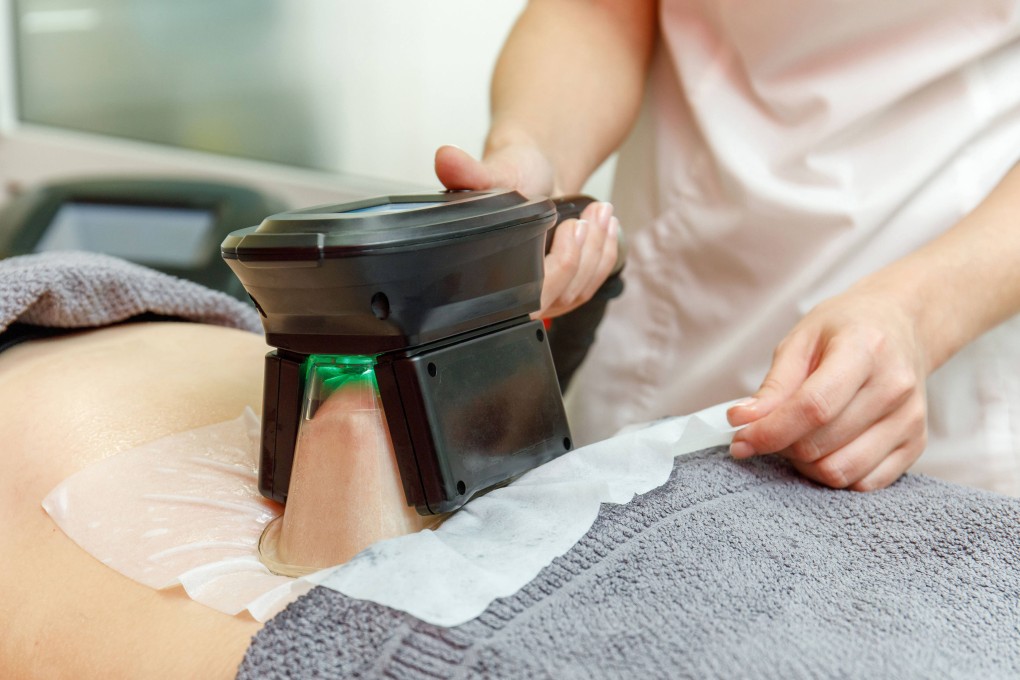 A beauty therapist uses CoolSculpting, or cryolipolysis, on a patient. However, a rare side effect of the procedure, called paradoxical adipose hyperplasia, can cause fat cells to increase.