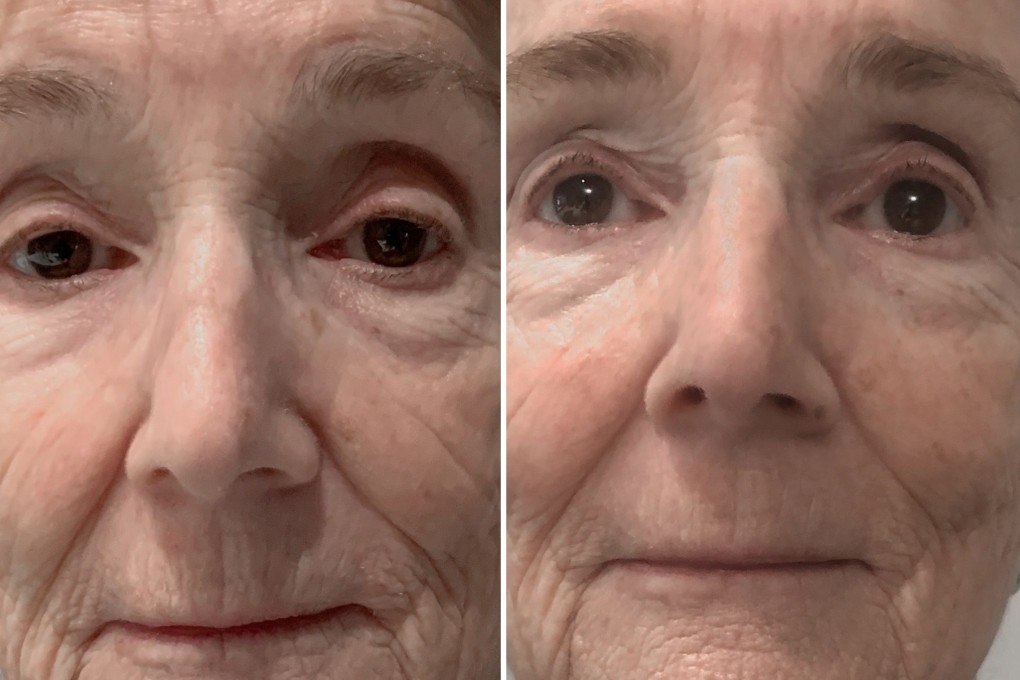 A set of before and after pictures from a customer using the Lyma Laser. The laser is the brainchild of Lucy Goff and is a skincare device that claims to completely remodel your skin.