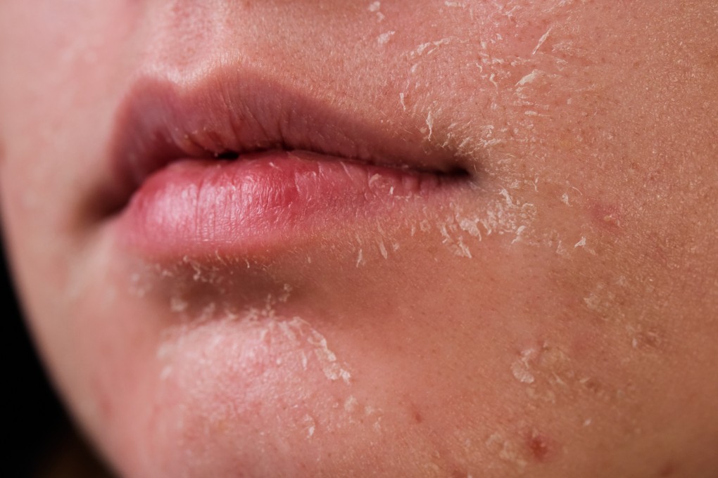 Although dry skin and dehydrated skin can feel very similar, there is a huge difference between the two. Photo: Shutterstock