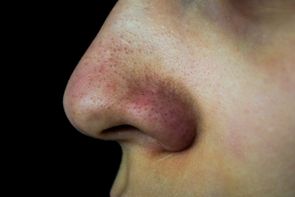 Blackheads are seemingly impossible to get rid of, and they always seem to crop up on the nose. Photo: Shutterstock