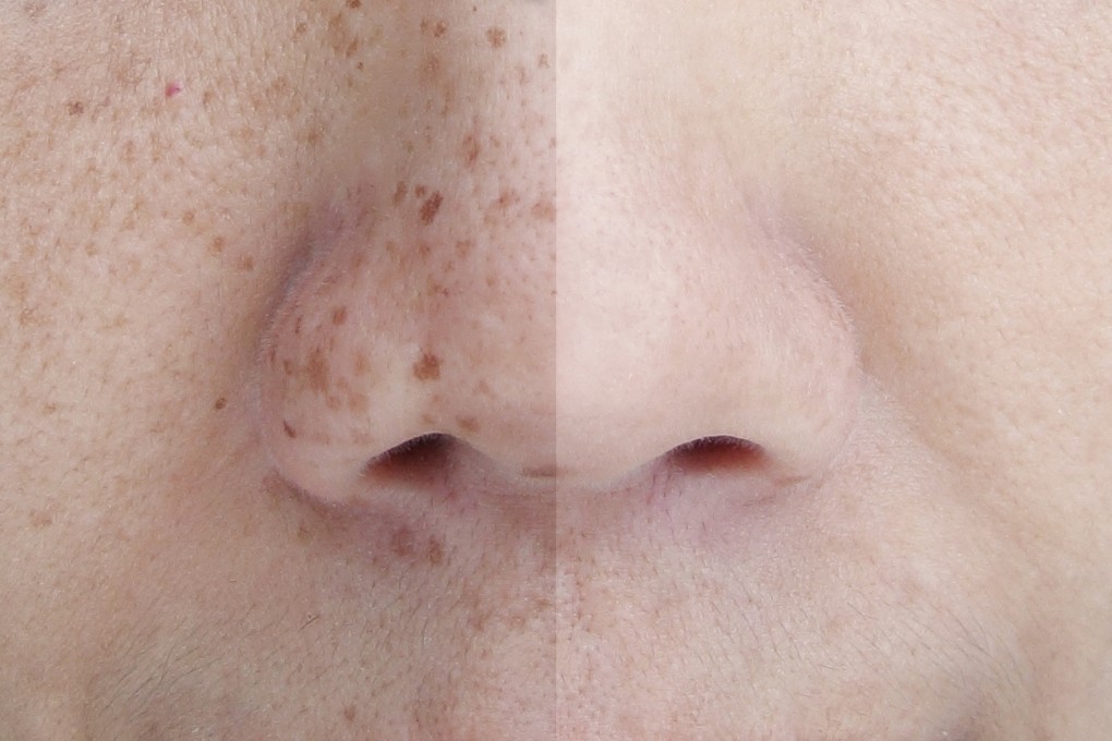 Dark spots, or hyperpigmentation, can be caused by a number of things, from ageing to sun exposure. Photo: Shutterstock