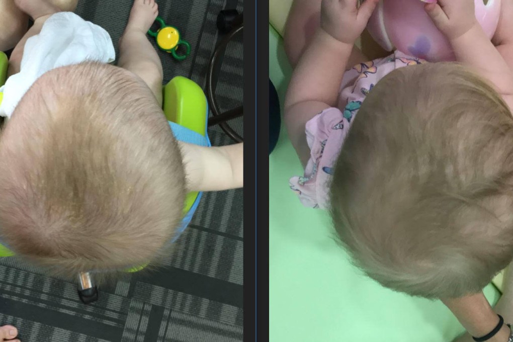 Two photos, taken four months apart, show a baby with flat head syndrome and after treatment with a custom helmet.