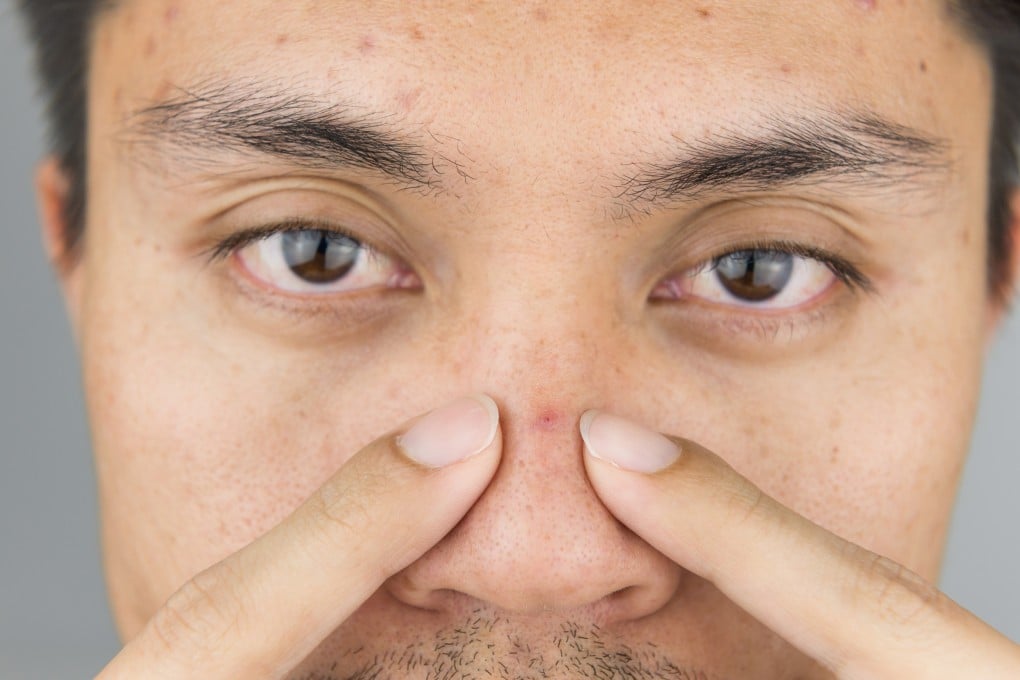 Be careful when treating acne around the nose and top lip area, also known as the “triangle of death”, because it could lead to serious infection. Photo: Shutterstock