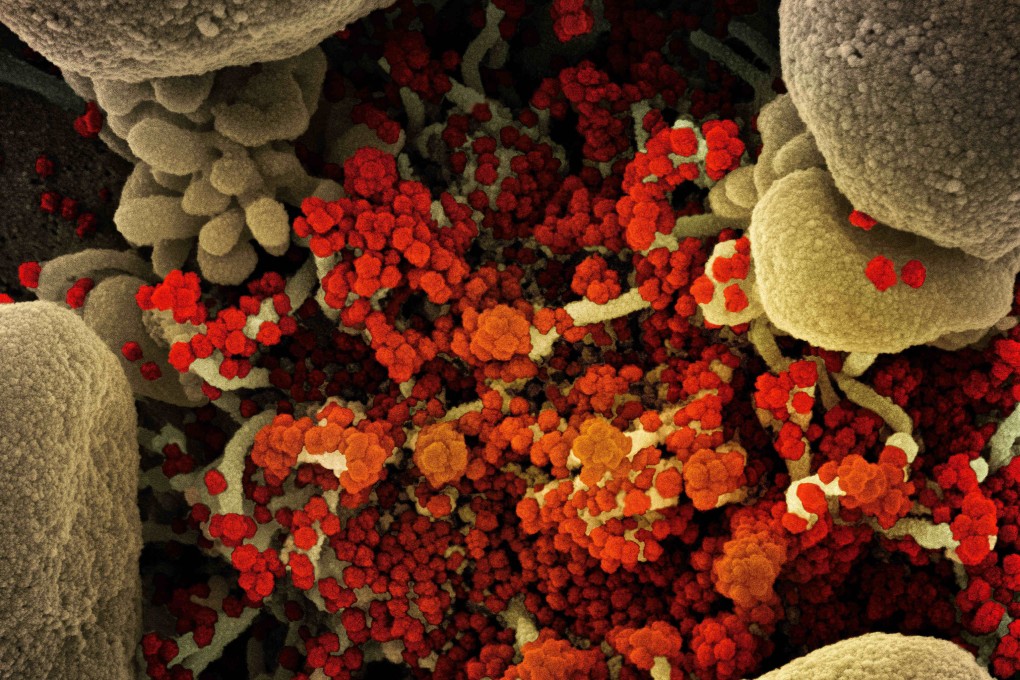 A colourised scanning electron micrograph of a cell heavily infected with SARS-CoV-2 virus particles (orange/red), isolated from a patient sample. Photo: TNS