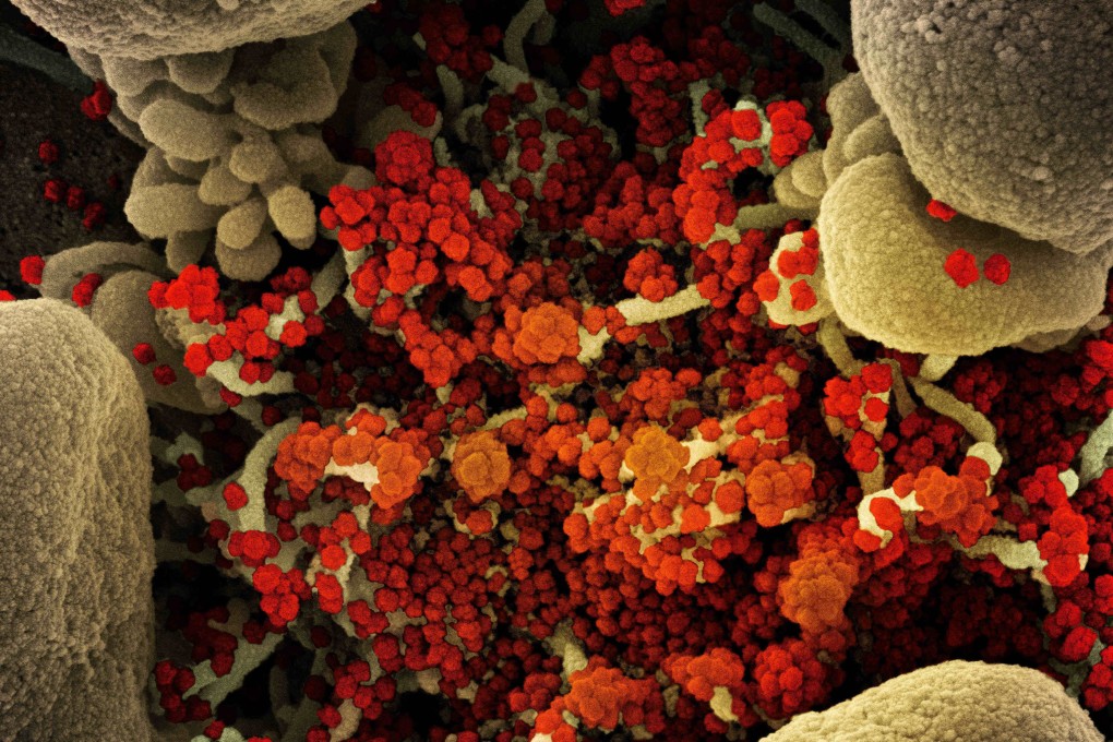 A colourised micrograph of a cell heavily infected with SARS-CoV-2 virus particles (orange/red), isolated from a patient sample. The image was captured at the Integrated Research Facility at the National Institute of Allergy and Infectious Diseases, US. Photo: TNS