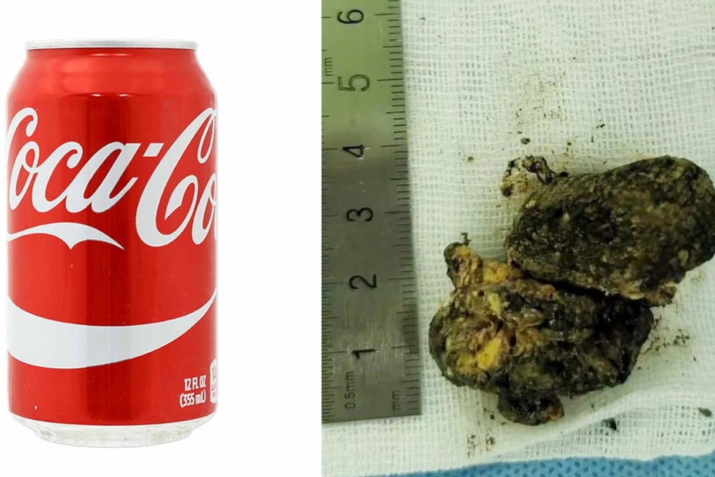 A young girl had large stomach stones removed (right) with the help of drinking cola. Photo: Handout