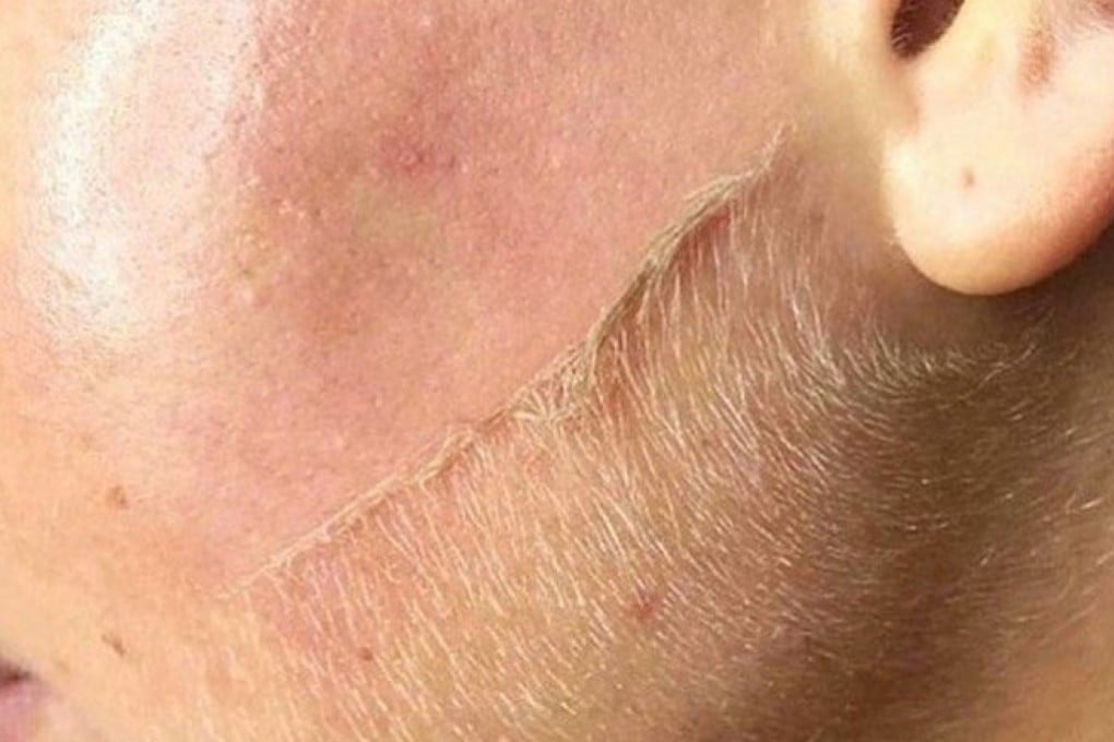 Dermaplaning, or face shaving, helps get rid of facial hairs, and more women are being open on social media about doing it. Consult a dermatologist before you try it at home. Photo: courtesy of Instagram