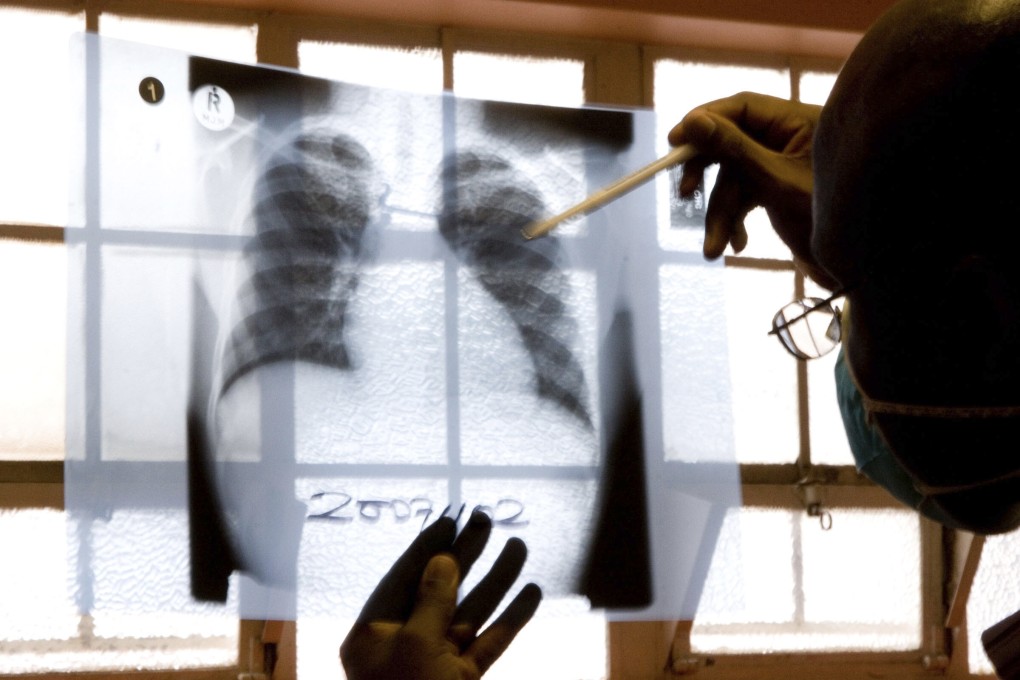 A doctor examines chest X-rays at a tuberculosis clinic. Photo: AP