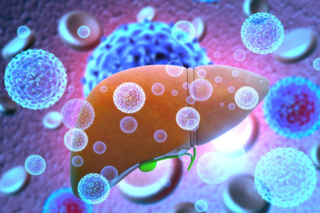 A 3D illustration shows a liver infected with hepatitis viruses. Seventeen of the children with the new strain needed a liver transplant. Image: Handout