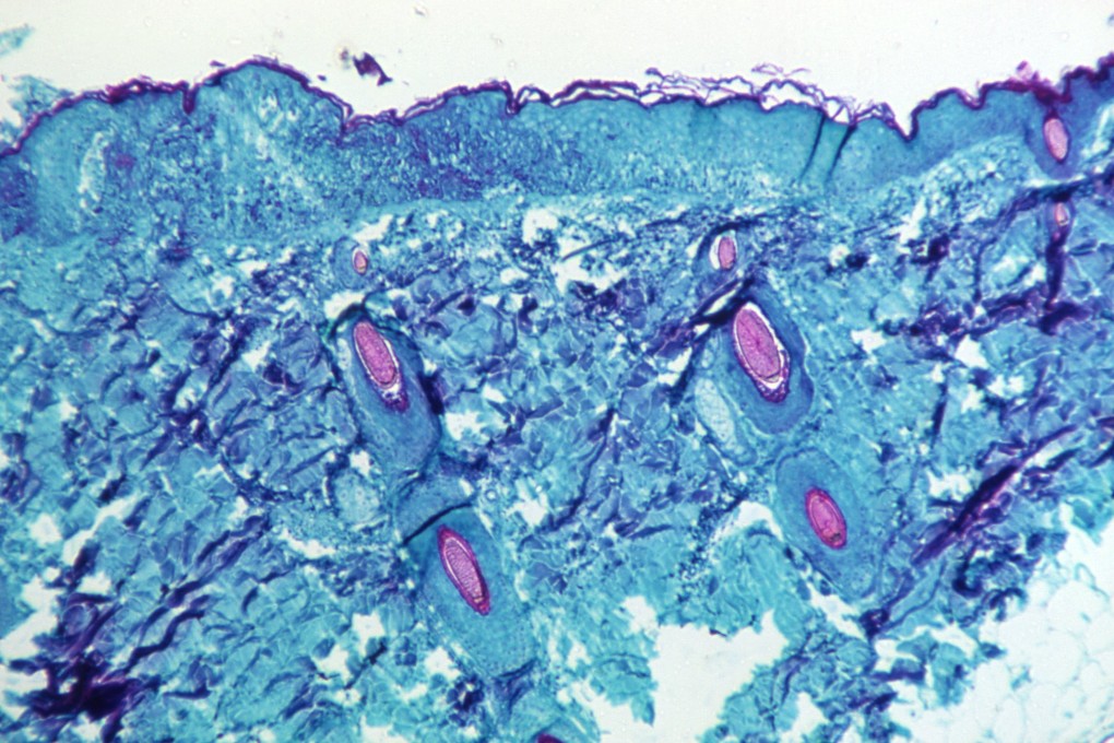 A section of skin tissue, harvested from a lesion on the skin of a monkey, that had been infected with monkey pox virus, is seen at 50X magnification. Image: US CDC via Reuters