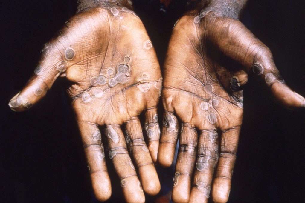 The palms of a monkeypox case patient. Photo: CDC/Handout via Reuters
