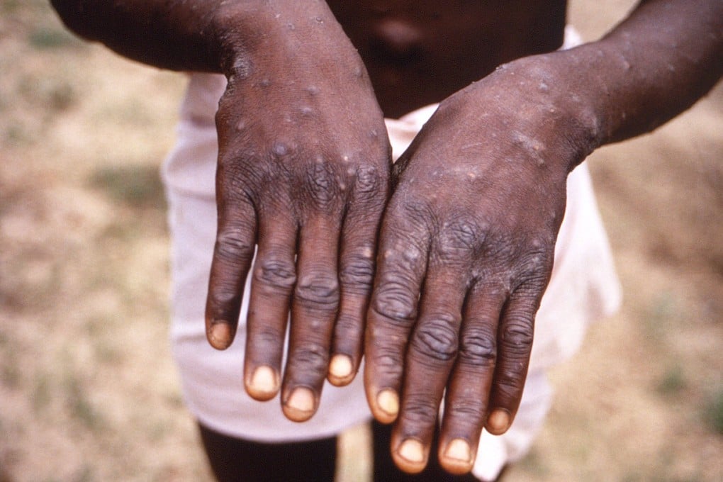The disease causes lesions on the skin. Photo: AFP