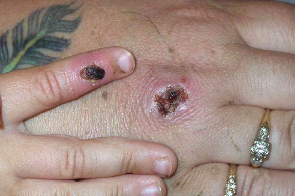 Health authorities have unveiled a three-tiered response plan to combat a potential outbreak of monkeypox. Photo: Getty Images