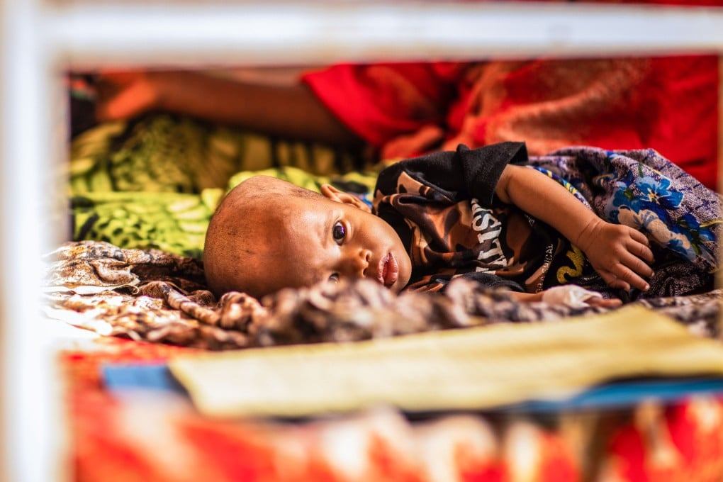 A severely malnourished child receives treatment at Gode Hospital in Somali, Ethiopia, on April 12. The region is braced for its most severe drought in 40 years amid a global food crisis made worse by the Ukraine war. Photo: UNICEF via AP
