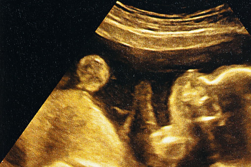 A scan of an embryo at 24 weeks. Fertility clinics claim new DNA tests can assess whether one embryo is more likely than the next to develop a range of illnesses long thought to be beyond DNA-based prediction. Photo: Getty Images