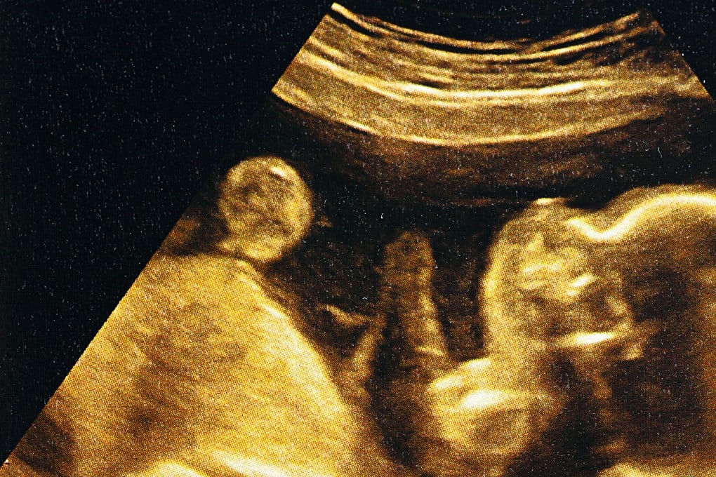 A scan of an embryo at 24 weeks. Fertility clinics claim new DNA tests can assess whether one embryo is more likely than the next to develop a range of illnesses long thought to be beyond DNA-based prediction. Photo: Getty Images