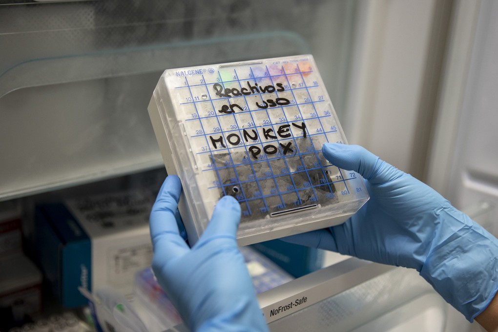 A medical technician picks up a reactive for testing suspected monkeypox samples at a hospital laboratory in Madrid, Spain on June 6. Photo: TNS
