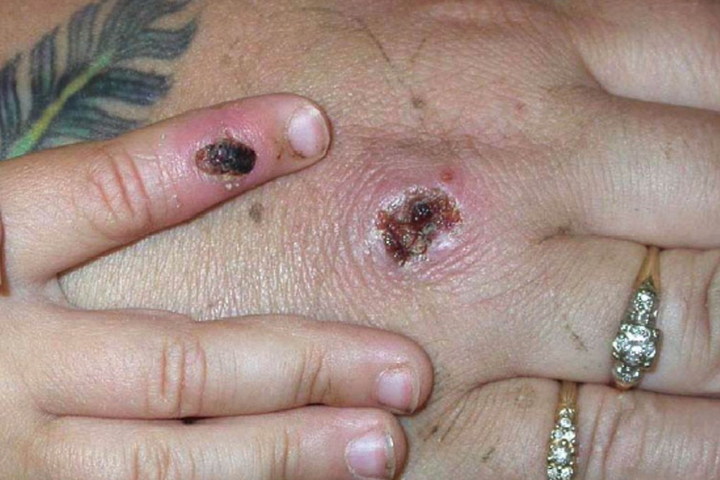 One of the first known cases of the monkeypox virus on a patient’s hand. Photo: Getty Images