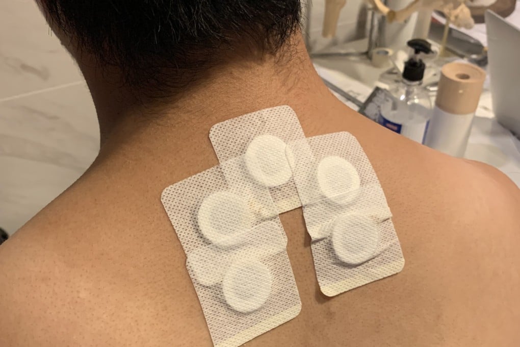 In the traditional Chinese medicine treatment of san fu moxibustion, plasters containing a warm herbal paste are applied to acupressure points, usually on the upper back. Photo: Samuel To