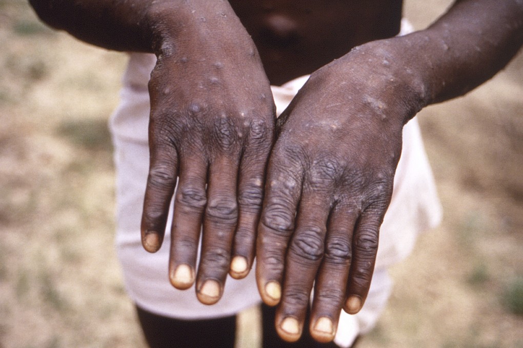 The World Health Organization has declared the monkeypox outbreak a public health emergency of international concern. Photo: AP
