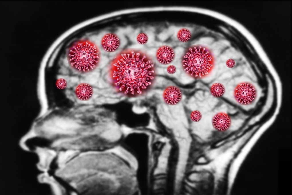 Many Covid-19 survivors have experienced cognitive issues. Photo: Shutterstock
