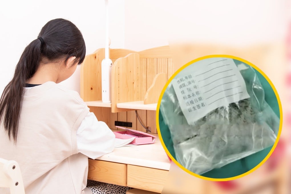 Doctors in China spend more than 10 hours removing a 1kg hairball from a 9-year-old girl’s stomach after she swallowed it to get more attention. Photo: SCMP composite