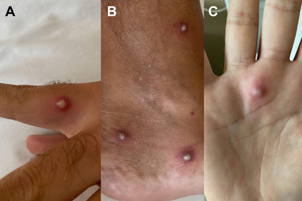 The patient developed small, painful blisters after first breaking out in a rash. Photos: Journal of Infection