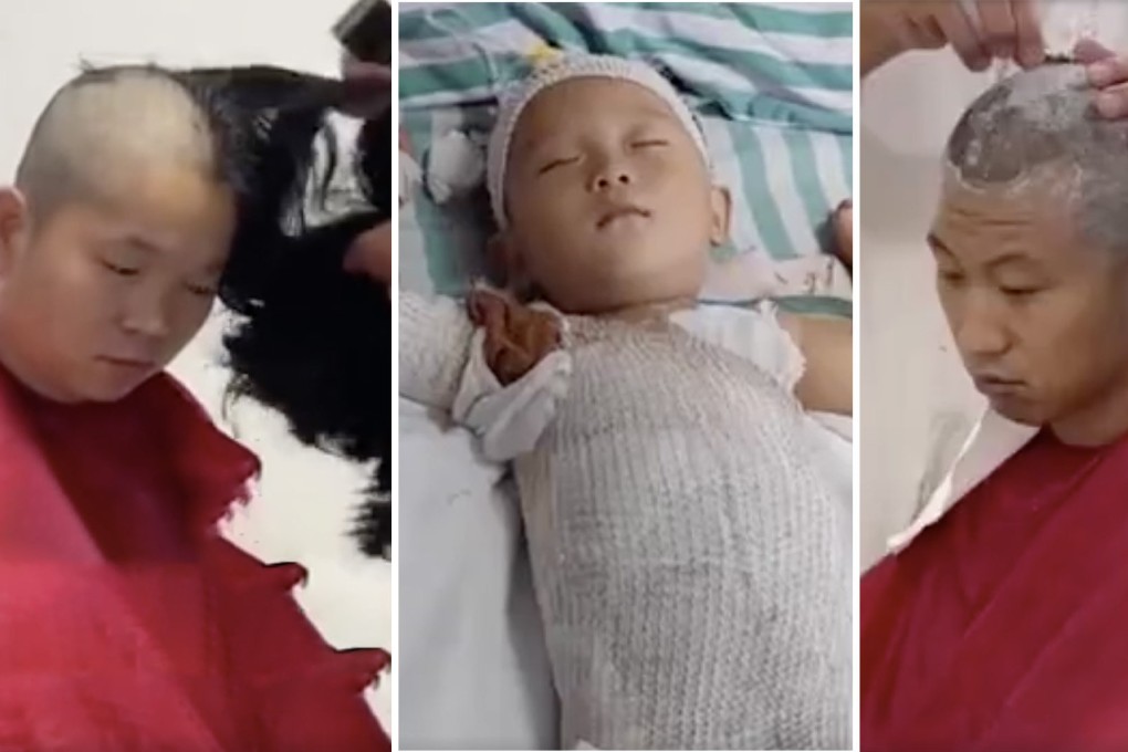 A mother and father shave their heads to donate skin from their scalps for their badly burnt son’s transplant surgery. Photo: SCMP composite