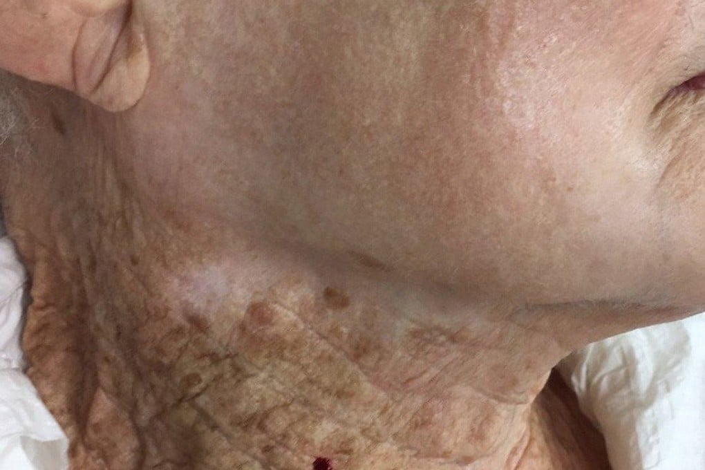 A 92-year-old used sunscreen on her face but not her neck for more than 40 years. The sun damage contrast can be seen in this striking photo. Photo: Twitter