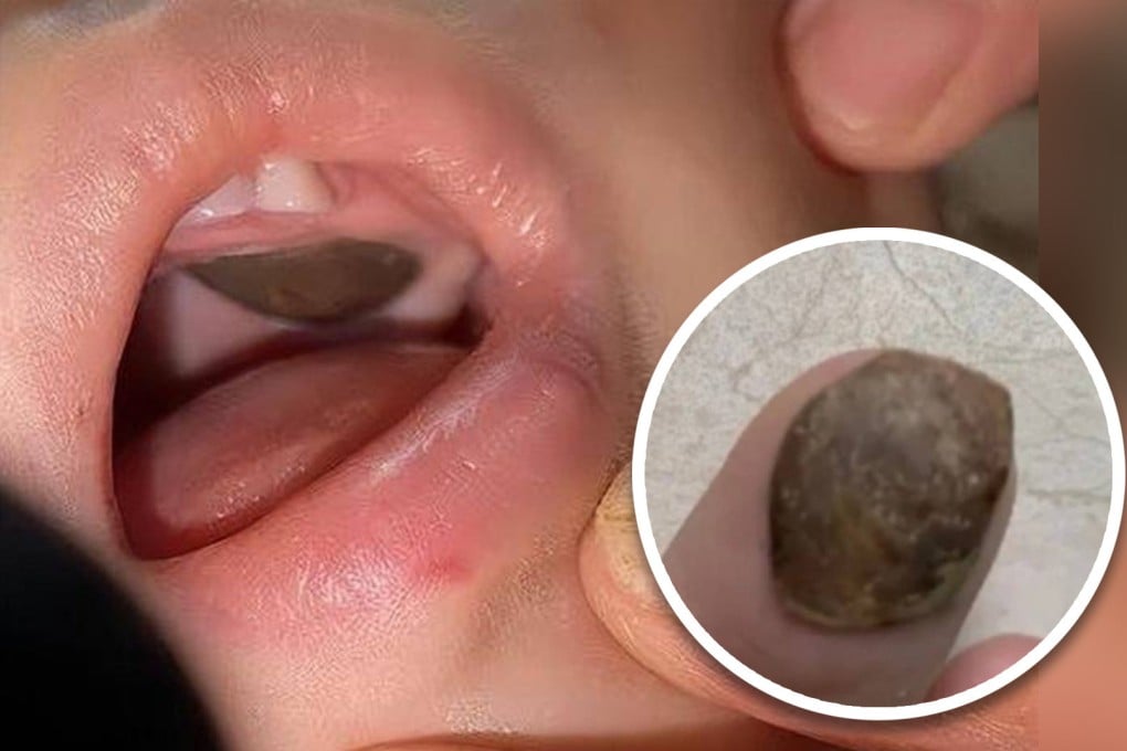 A doctor and hospital in China are accused of malpractice after telling parents their baby had a tumour, later found to be a lotus seed shell. Photo: SCMP Composite