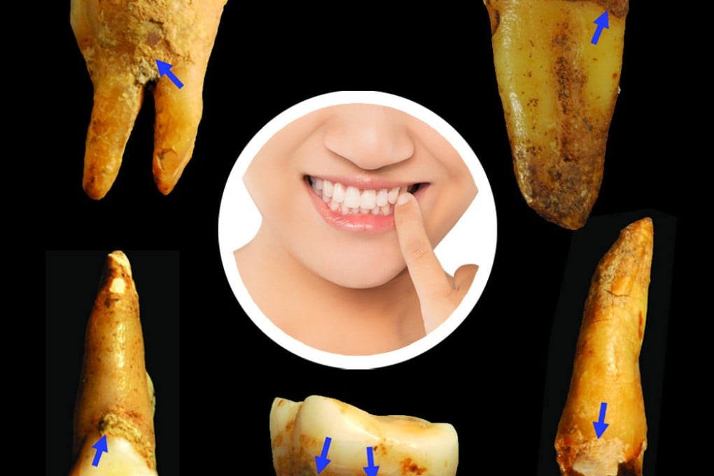 Chinese scientists believe they found one of the oldest examples of the earliest humans picking their teeth. Photo: SCMP composite