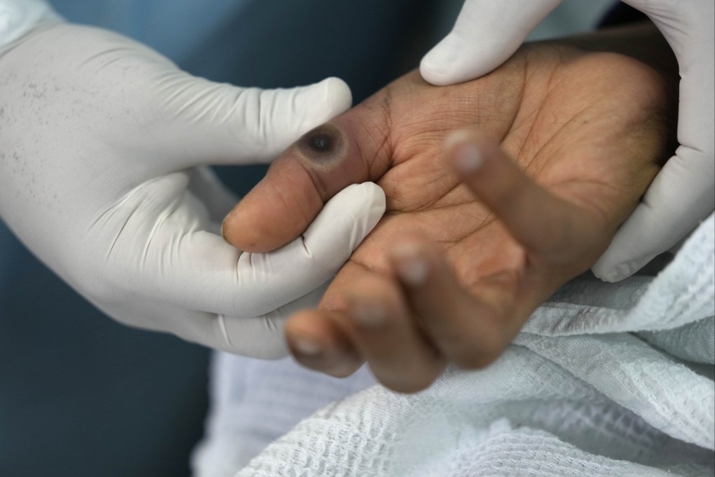 Symptoms include rashes and sores. Photo: AP