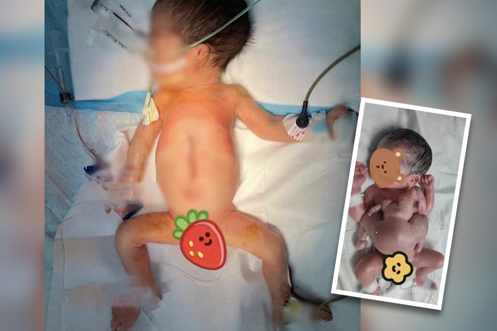 A parasite fetus is a rare congenital abnormality where a malformed fetus develops on the body of its twin. It took doctors more than 3 hours to remove from the boy (above) Photo: SCMP composite