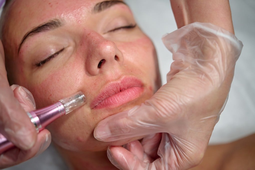 Microneedling involves the use of tiny needles to make microscopic punctures in the skin. A Post reporter recounts her experience of it in Hong Kong. Photo: Shutterstock