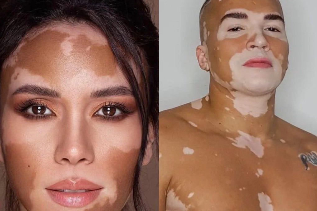 A Cure For Vitiligo New Us 2 000 Treatment Is Restoring Skin A Cure For Vitiligo New Us 2 000 Treatment Is Restoring Skin