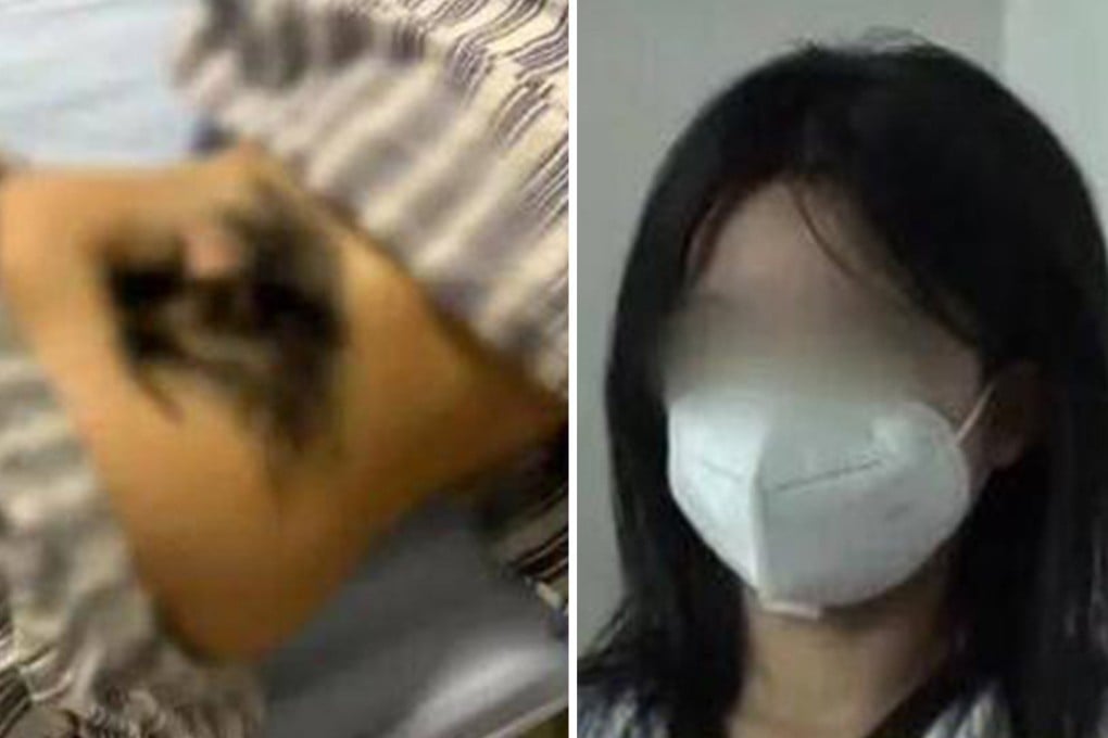 A teenage girl in China has spinal surgery to remove bones and cure her of a deformity that causes dark hair to grow across her lower back. Photo: SCMP composite